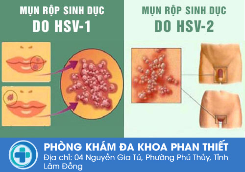 Ngứa bộ phận sinh dục nam là bị gì?