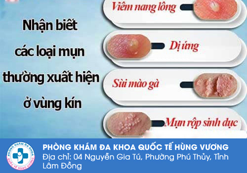 Tình trạng nổi mụn thịt vùng kín nữ là bệnh gì?