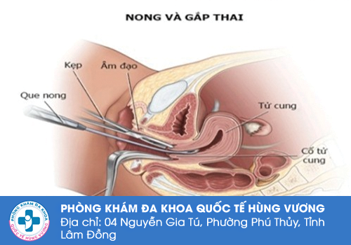 Cách phá thai an toàn bằng phẫu thuật