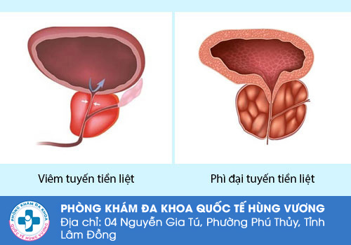 Tiểu buốt ở nam giới do phì đại tuyến tiền liệt