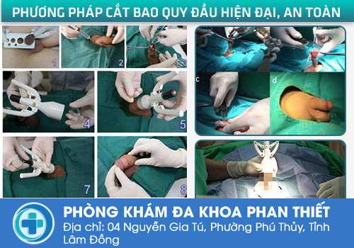 Điều trị chuỗi hạt ngọc dương vật thế nào hiệu quả