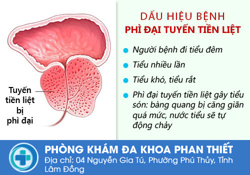 Triệu chứng phì đại tuyền tiền liệt như thế nào?