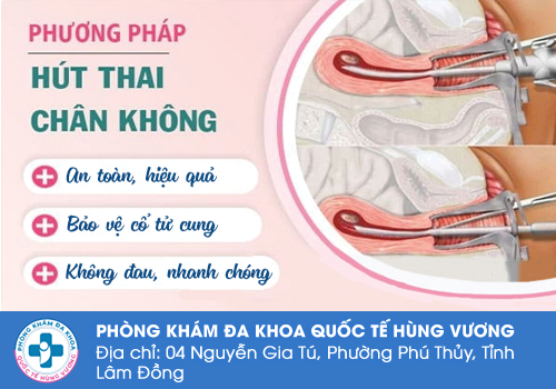 Cách bỏ thai an toàn bằng phương pháp hút thai chân không
