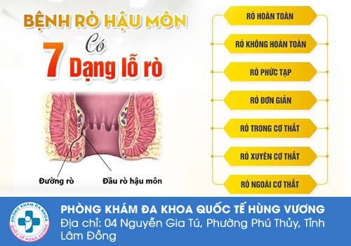 Nguyên nhân rò hậu môn là gì?