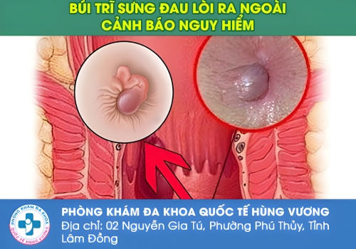 Hình ảnh sa búi trĩ.