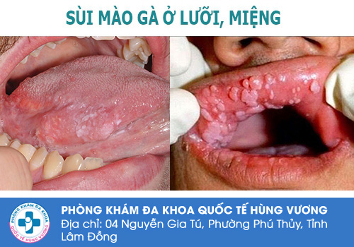 Sùi mào gà ở lưỡi có biểu hiện như thế nào?