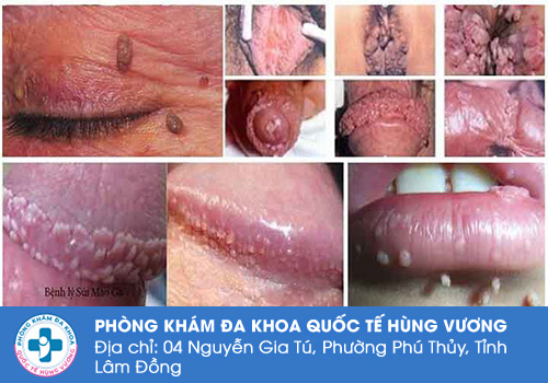 Tổng quan bệnh sùi mào gà ở nam giới