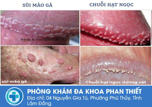 Hạt ngọc dương vật là gì