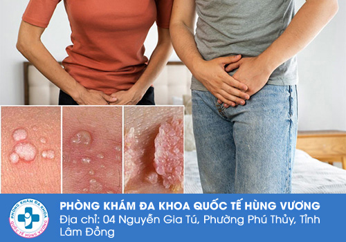 Nổi mụn âm đạo – Dấu hiệu cảnh báo nhiều bệnh lý nguy hiểm