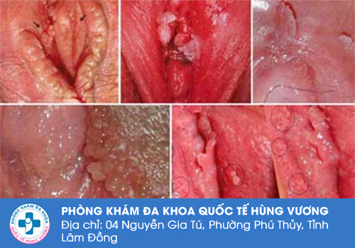 Xuất hiện thịt thừa vùng kín do sùi mào gà