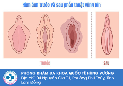 Chỉnh âm đạo bao lâu thì lành?