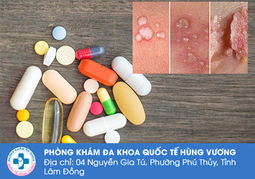 Sùi mào gà uống thuốc gì? 