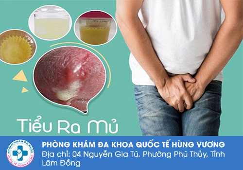 Hiện tượng tiểu buốt có mủ ở nam giới