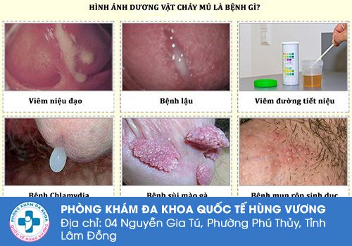 Tiểu buốt chảy mủ là bệnh gì?