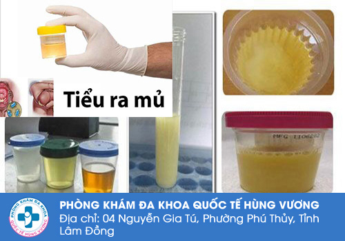 Nam giới tiểu buốt ra mủ là bệnh gì?