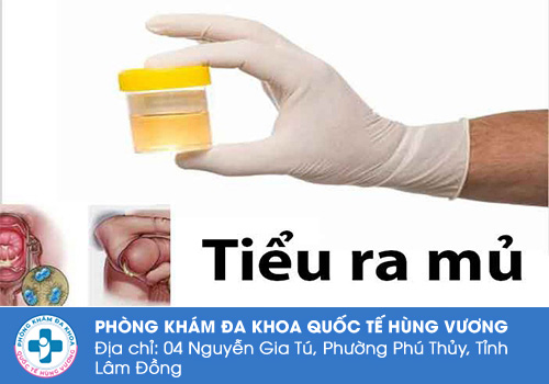 Tiểu buốt ra mủ là gì?