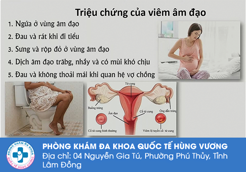 Nổi thịt thừa cửa mình do bệnh viêm âm đạo