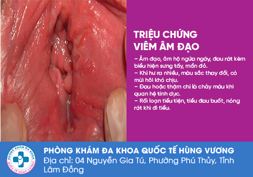 Xuất hiện thịt thừa vùng kín do viêm âm đạo