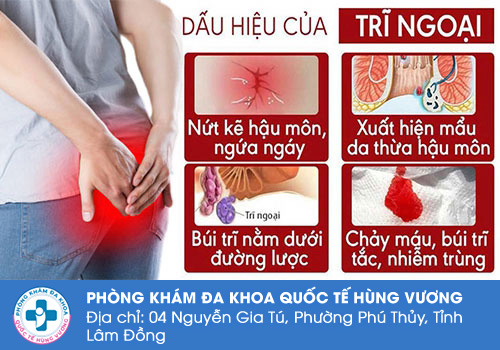 Sa búi trĩ có triệu chứng như thế nào?