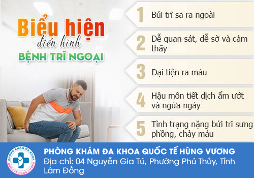 Sa búi trĩ là gì?