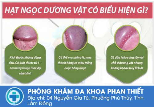 Hạt ngọc dương vật mọc ở đâu? Dấu hiệu nhận biết 