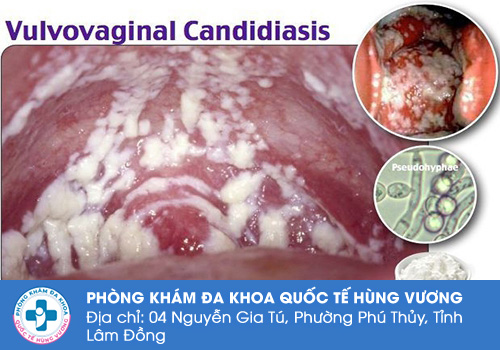 Triệu chứng nấm phụ khoa thường gặp