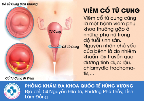 Chua âm đạo do viêm cổ tử cung