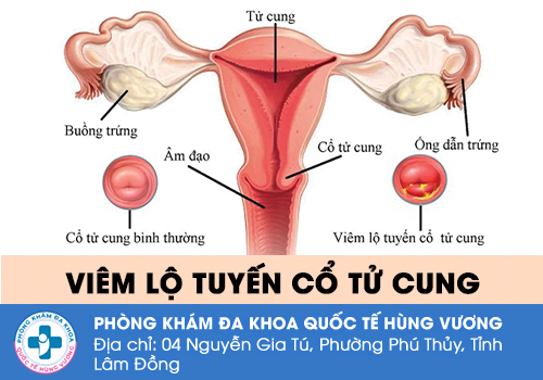 Viêm lộ tuyến cổ tử cung là gì?