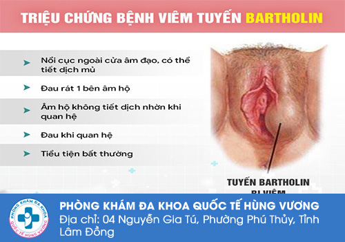 Nổi mụn cứng vùng kín không đau ở nữ giới là bệnh gì?