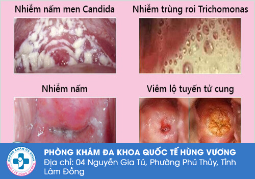 Nguyên nhân dẫn đến tình trạng huyết trắng bột