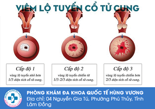 Hôi âm đạo do viêm lộ tuyến cổ tử cung
